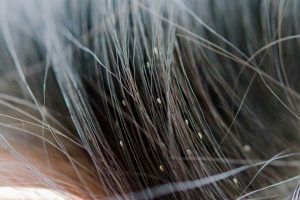 Come si prendono i pidocchi: attenzione a questi gesti